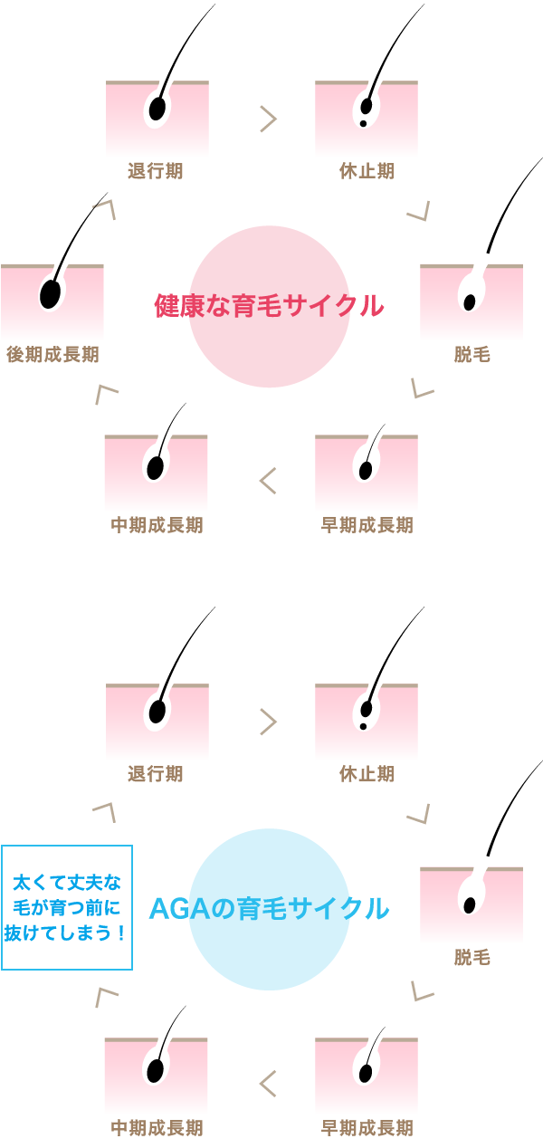 健康な育毛サイクルとAGAの育毛サイクル(イラスト)